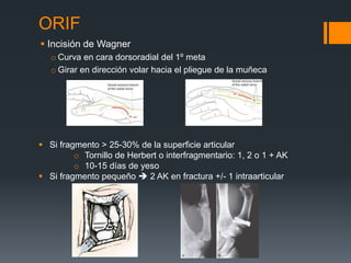 fracturas 1º metacarpiano de la mano y tratamiento | PPTX