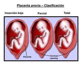 • Placenta previa anterior
• Cesárea anterior o cirugía uterina previa
• Gestación múltiple
• Edad materna avanzada
• Mult...