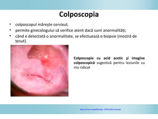 Colposcopia
• colposcopul măreşte cervixul;
• permite ginecologului să verifice atent dacă sunt anormalităţi;
• când e detectată o anormalitate, se efectuează o biopsie (mostră de
ţesut).
Colposcopie cu acid acetic şi imagine
colposcopică sugestivă pentru leziunile cu
risc ridicat
http://ircon.ro/pdf/Study- CERVUGID-Ovoules
 