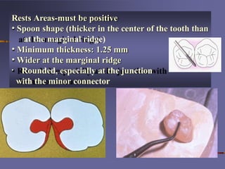 Marginal Ridge Rests (1)Mouth preparation for removable partial denture march 2020 ppt.pptx