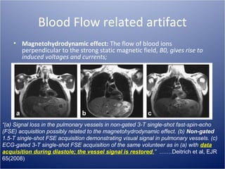 Blood Flow related artifact
• Magnetohydrodynamic effect: The flow of blood ions
perpendicular to the strong static magnetic field, B0, gives rise to
induced voltages and currents;

“(a) Signal loss in the pulmonary vessels in non-gated 3-T single-shot fast-spin-echo
(FSE) acquisition possibly related to the magnetohydrodynamic effect. (b) Non-gated
1.5-T single-shot FSE acquisition demonstrating visual signal in pulmonary vessels. (c)
ECG-gated 3-T single-shot FSE acquisition of the same volunteer as in (a) with data
acquisition during diastole; the vessel signal is restored.” …….Deitrich et al, EJR
65(2008)

 