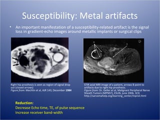Susceptibility: Metal artifacts
•

An important manifestation of a susceptibility-related artifact is the signal
loss in gradient-echo images around metallic implants or surgical clips

Right hip prosthesis is seen as region of signal drop
out (closed arrows)
Figure from: Mechlin et al, AJR 143, December 1984

STIR axial MRI image of a patient, arrows B point to
artifacts due to right hip prosthesis.
Figure from: Dr. Geller et al, Malignant Peripheral Nerve
Sheath Tumors (MPNST), ESUN, june 2006, 3(3)
http://sarcomahelp.org/learning_center/mpnst.html

Reduction:
Decrease Echo time, TE, of pulse sequence
Increase receiver band-width

 