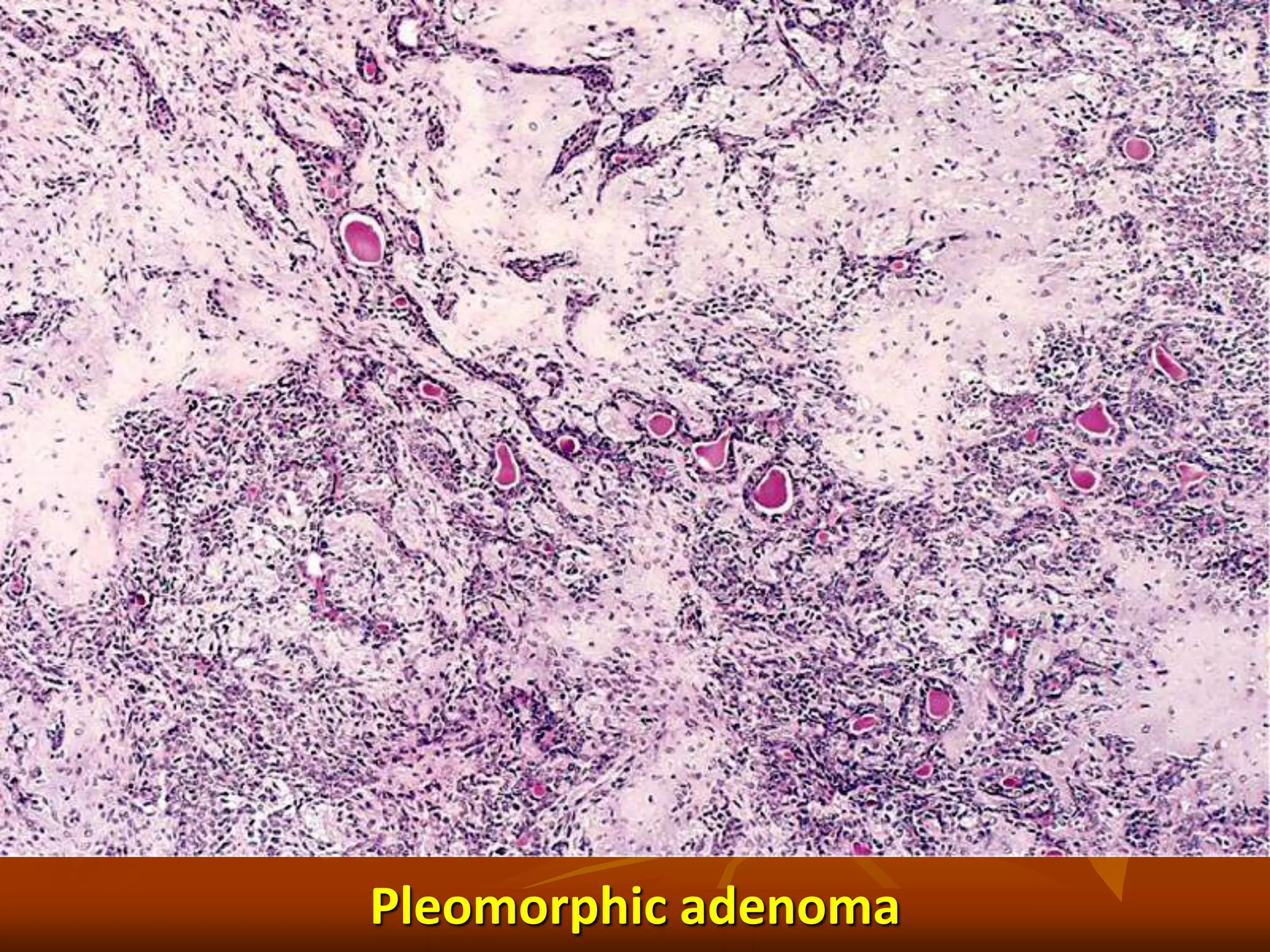 Pleomorphic adenoma
 