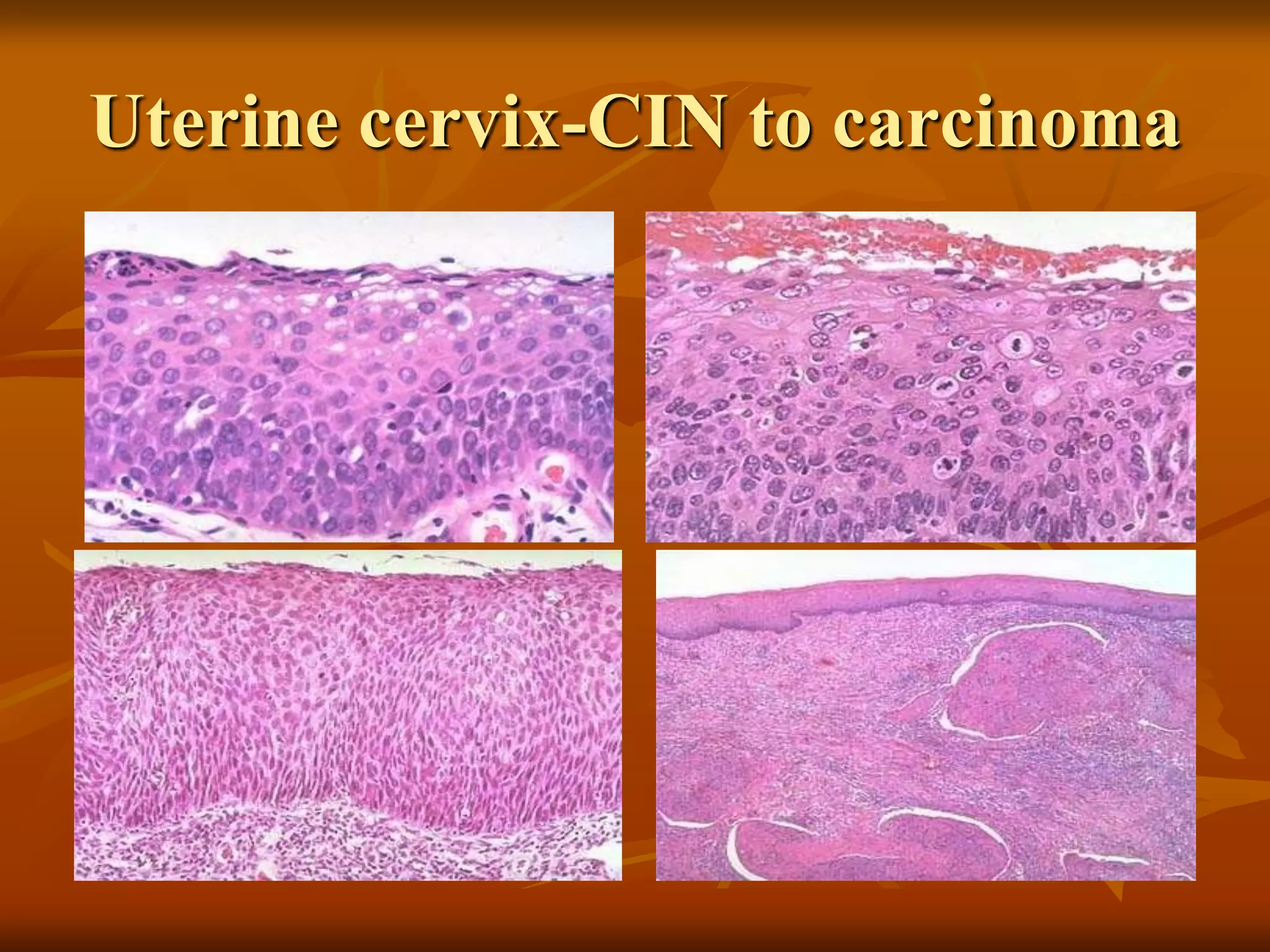 Uterine cervix-CIN to carcinoma
 
