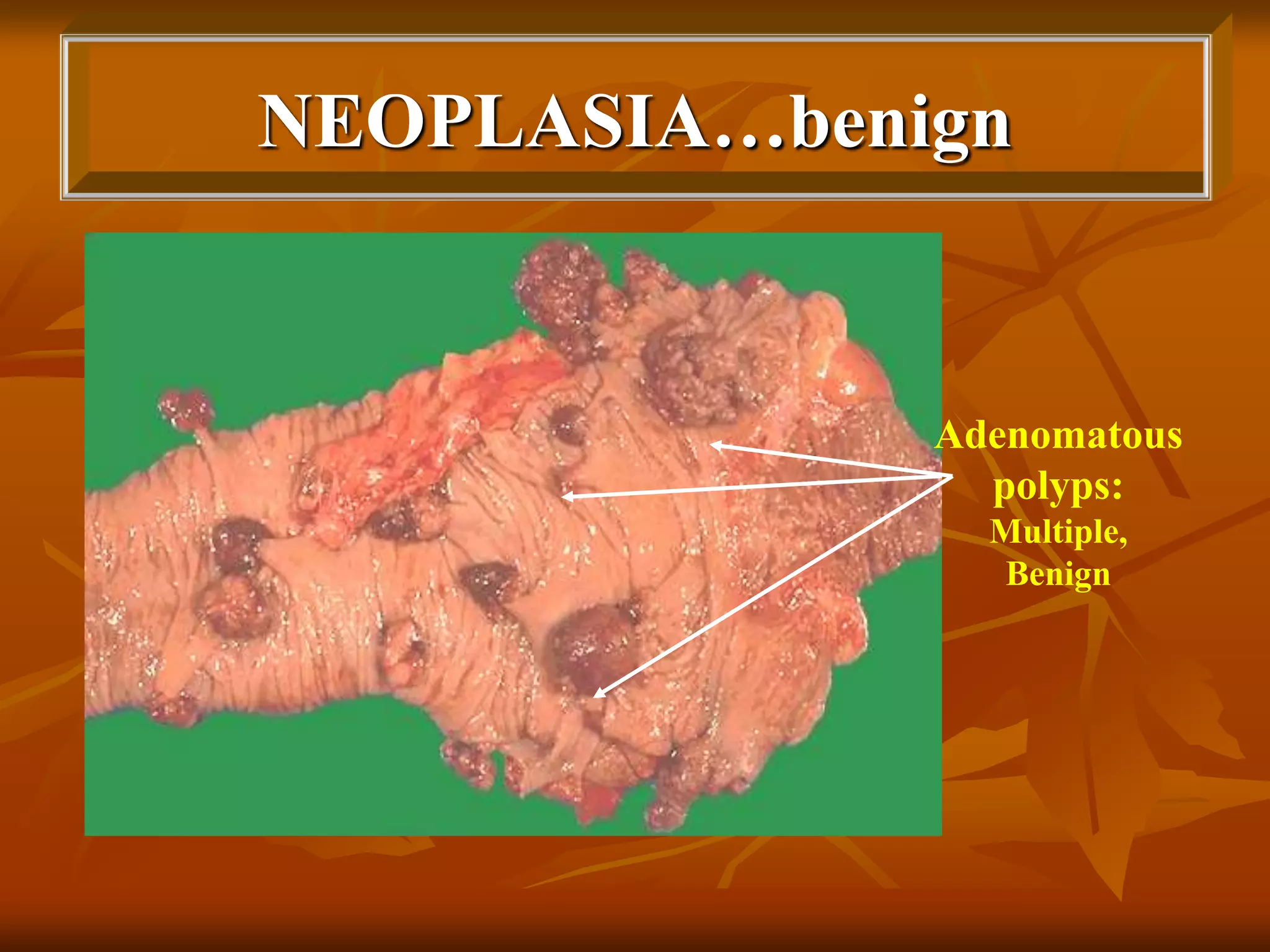 NEOPLASIA…benign
Adenomatous
polyps:
Multiple,
Benign
 