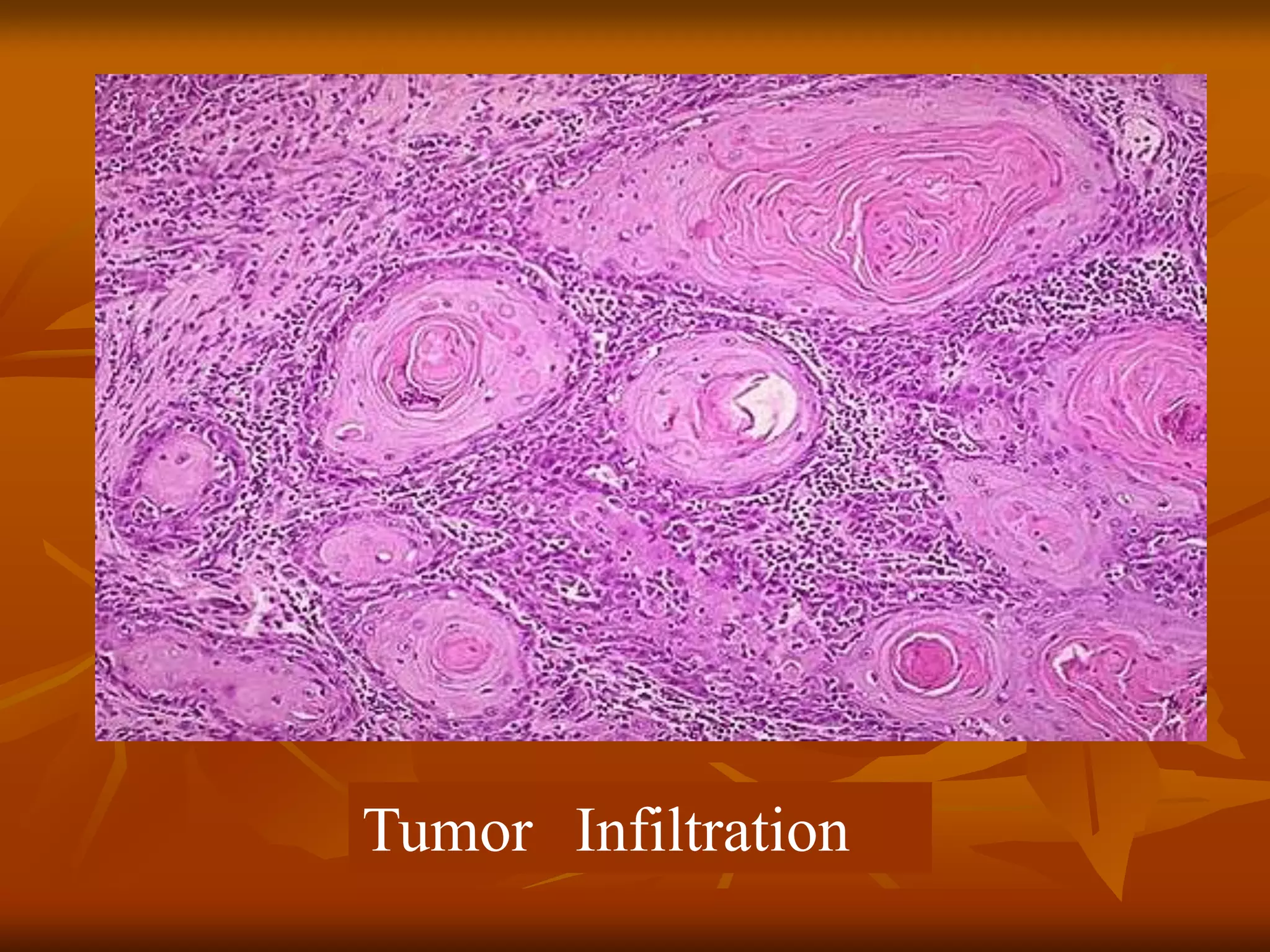 Tumor Infiltration
 