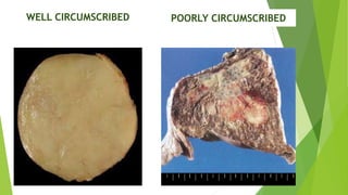 WELL CIRCUMSCRIBED POORLY CIRCUMSCRIBED
 
