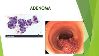 ADENOMA
 