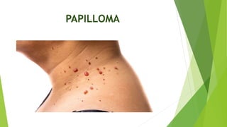PAPILLOMA
 