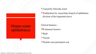 Herpes zoster
ophthalmicus
 Caused by Varicella zoster
 Predilection for nasociliary branch of ophthalmic
division of the trigeminal nerve.
Clinical features:-
Cutaneous lesions:-
Rash
Vesicle
Pustule crust permanent scar
Rajendran R. Shafer's textbook of oral pathology. Elsevier India; 2009.
 