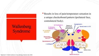 Wallenberg
Syndrome
 Results in loss of pain/temperature sensation in
a unique checkerboard pattern (ipsilateral face,
contralateral body).
Rajendran R. Shafer's textbook of oral pathology. Elsevier India; 2009.
 