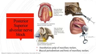Posterior
Superior
alveolar nerve
block
• Anesthetizes pulp of maxillary molars.
• Buccal periodontium and bone of maxillary molars.
Malamed SF. Handbook of Local Anesthesia, 7e: South Asia Edition. Elsevier India; 2019 Aug 27.
 