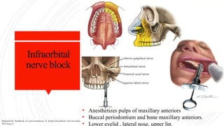 Infraorbital
nerve block
• Anesthetizes pulps of maxillary anteriors
• Buccal periodontium and bone maxillary anteriors.
• Lower eyelid , lateral nose, upper lip.
Malamed SF. Handbook of Local Anesthesia, 7e: South Asia Edition. Elsevier India;
2019 Aug 27.
 