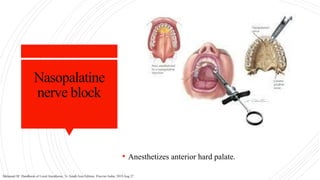Nasopalatine
nerve block
• Anesthetizes anterior hard palate.
Malamed SF. Handbook of Local Anesthesia, 7e: South Asia Edition. Elsevier India; 2019 Aug 27.
 