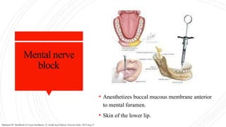 Mental nerve
block
• Anesthetizes buccal mucous membrane anterior
to mental foramen.
• Skin of the lower lip.
Malamed SF. Handbook of Local Anesthesia, 7e: South Asia Edition. Elsevier India; 2019 Aug 27.
 