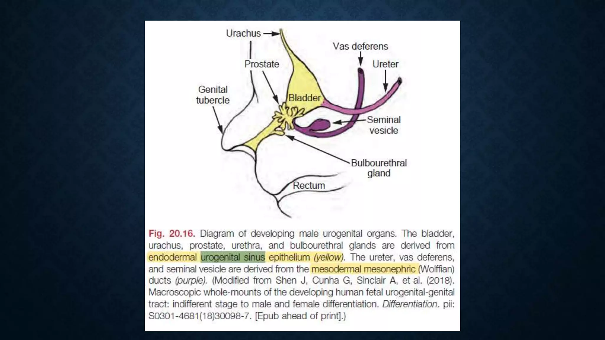Evaluation of urogenital sinus and cloacal anomalies | PPTX