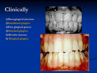 Clinically
1)Mucogingival junction.
2)Interdental gingiva.
3)Free gingival groove
4)Attached gingiva.
5)Alveolar mucosa
6) Marginal gingiva.
 