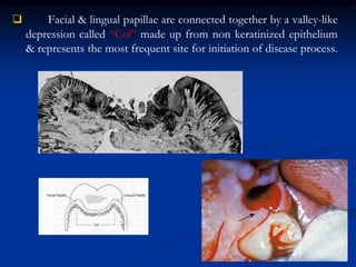  Facial & lingual papillae are connected together by a valley-like
depression called “Col” made up from non keratinized epithelium
& represents the most frequent site for initiation of disease process.
 