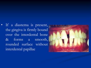 • If a diastema is present,
the gingiva is firmly bound
over the interdental bone
& forms a smooth,
rounded surface without
interdental papillae
 