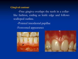 Gingival contour
-Free gingiva overlaps the teeth in a collar-
like fashion, ending as knife edge and follows
scalloped outline.
-Pointed interdental papillae
-Festooned appearance
 