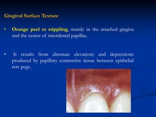 Gingival Surface Texture
• Orange peel or stippling, mainly in the attached gingiva
and the center of interdental papillae.
• It results from alternate elevations and depressions
produced by papillary connective tissue between epithelial
rete pegs .
 