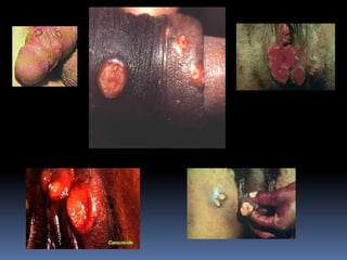 1o ano   ds ts - cancro mole