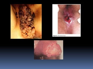 1o ano   ds ts - condiloma acuminado