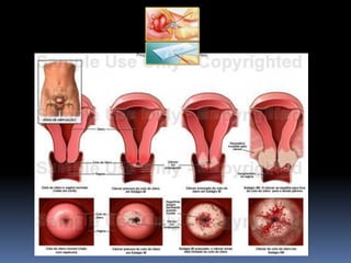 1o ano   ds ts - condiloma acuminado