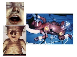 1o ano   ds ts - sífilis