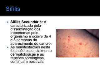  Sífilis Secundária: é
  caracterizada pela
  disseminação dos
  treponemas pelo
  organismo e ocorre de 4
  a 8 semanas do
  aparecimento do cancro.
 As manifestações nesta
  fase são essencialmente
  dermatológicas e as
  reações sorológicas
  continuam positivas.
 