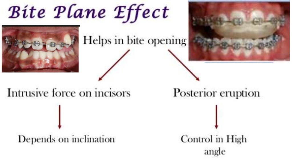 1 opening the bite with bite turbo