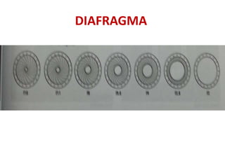 DIAFRAGMA
 