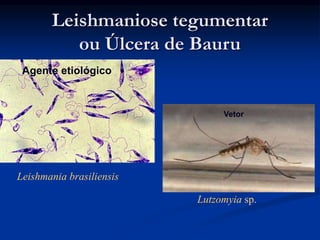 Leishmaniose tegumentar
ou Úlcera de Bauru
Leishmania brasiliensis
Lutzomyia sp.
Agente etiológico
Vetor
 