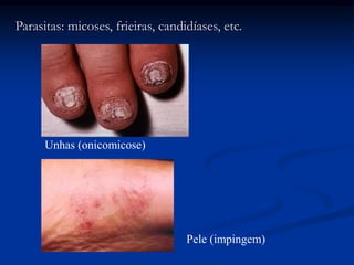 Parasitas: micoses, frieiras, candidíases, etc.
Unhas (onicomicose)
Pele (impingem)
 