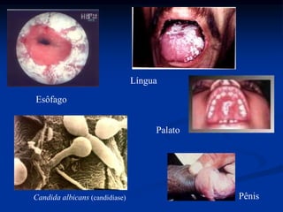 Esôfago
Pênis
Língua
Candida albicans (candidíase)
Palato
 