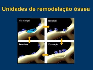 Unidades de remodelação óssea
 
