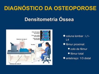  coluna lombar : L1-coluna lombar : L1-
L4L4
 fêmur proximal:fêmur proximal:
colo de fêmurcolo de fêmur
fêmur totalfêmur total
 antebraço: 1/3 distalantebraço: 1/3 distal
Densitometria ÓsseaDensitometria Óssea
DIAGNÓSTICO DA OSTEOPOROSE
 