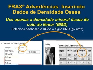 Selecione o fabricante DEXA e digite BMD (g / cm2)
Use apenas a densidade mineral óssea do
colo do fêmur (BMD)
FRAX®
Advertências: Inserindo
Dados de Densidade Óssea
 
