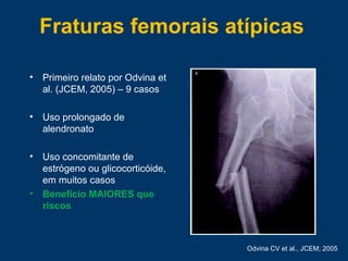 Fraturas femorais atípicas
• Primeiro relato por Odvina et
al. (JCEM, 2005) – 9 casos
• Uso prolongado de
alendronato
• Uso concomitante de
estrógeno ou glicocorticóide,
em muitos casos
• Benefício MAIORES que
riscos
Odvina CV et al., JCEM; 2005
 