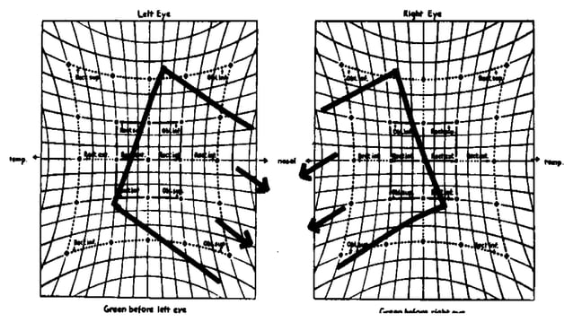 Diplopia Chart Normal Diplopia_Chart_and_Hess_Chart.pptx