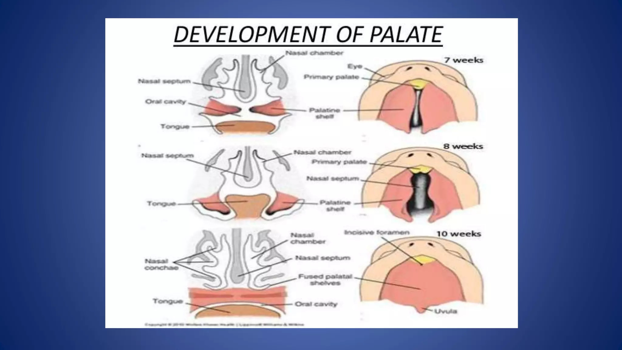 DEVELOPMENT OF PALATE AND ITS ANOMALIES | PPTX