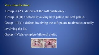 Veau Classfication DEVELOPMENT OF PALATE AND ITS ANOMALIES | PPTX
