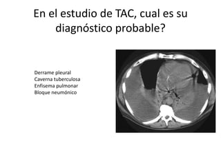 En el estudio de TAC, cual es su
diagnóstico probable?
Derrame pleural
Caverna tuberculosa
Enfisema pulmonar
Bloque neumón...