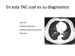 En esta TAC cual es su diagnostico
cavernas
metástasis pulmonar
tromboembolismo pulmonar
TBC miliar
 