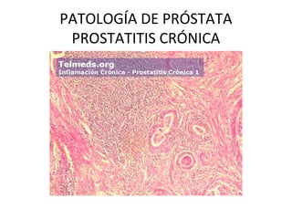 PATOLOGÍA DE PRÓSTATA
PROSTATITIS CRÓNICA
 