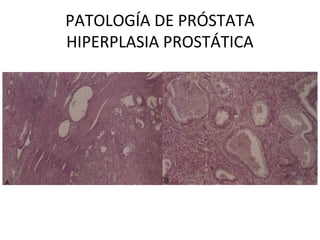 PATOLOGÍA DE PRÓSTATA
HIPERPLASIA PROSTÁTICA
 