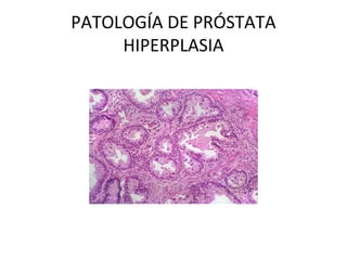 PATOLOGÍA DE PRÓSTATA
HIPERPLASIA
 