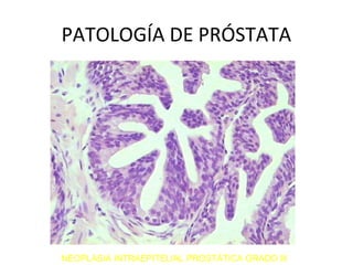 PATOLOGÍA DE PRÓSTATA
NEOPLASIA INTRAEPITELIAL PROSTÁTICA GRADO III
 