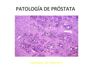 PATOLOGÍA DE PRÓSTATA
CARCINONA DE PRÓSTATA
 