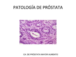 PATOLOGÍA DE PRÓSTATA
CA. DE PRÓSTATA MAYOR AUMENTO
 